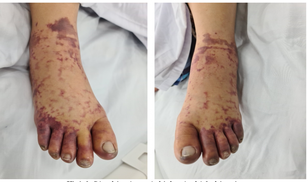 Diabetic Foot Care