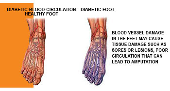 Introduction to Diabetic Foot Care - Explaining Neuropathy Damage