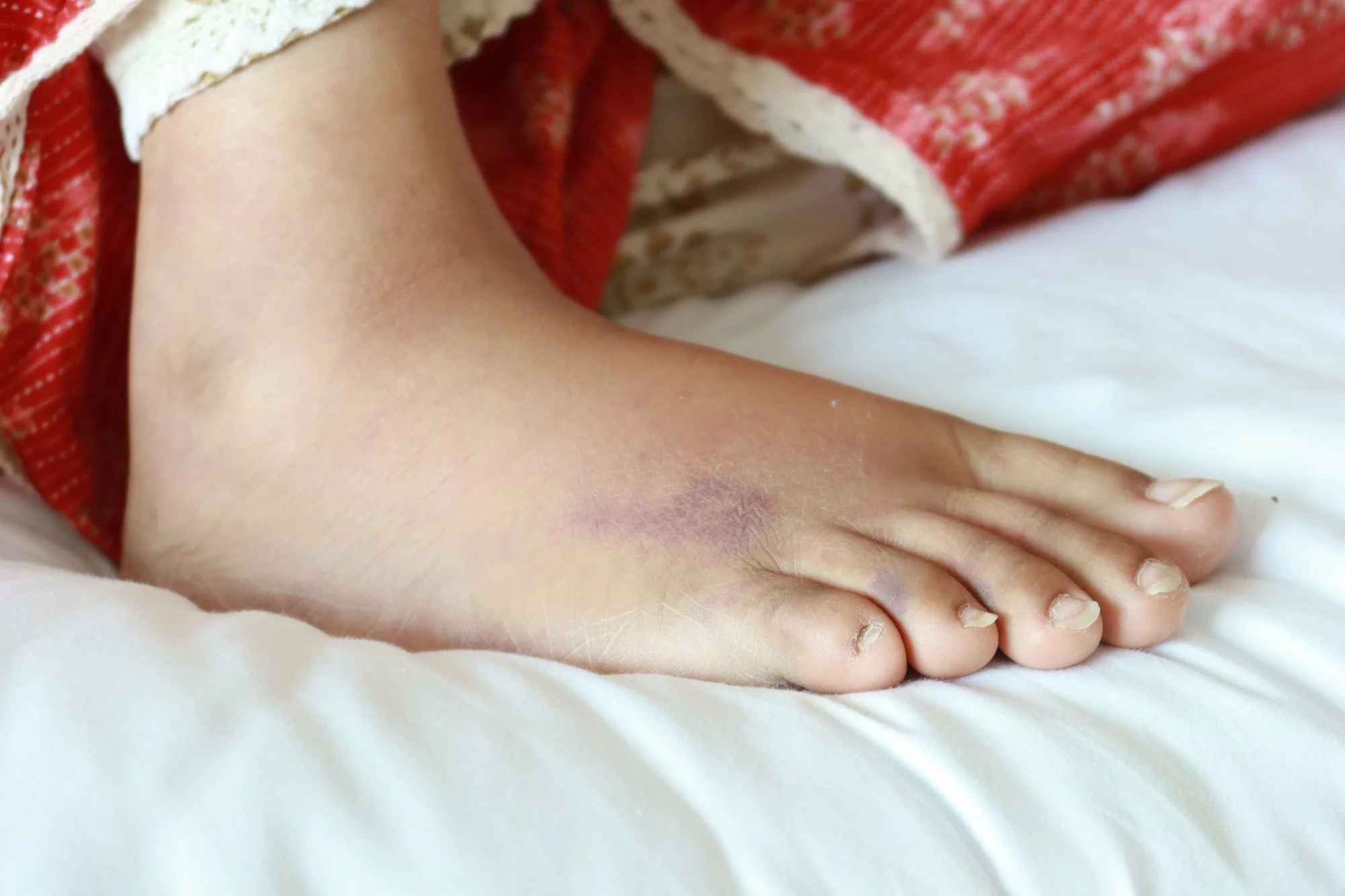 Giới thiệu về Chăm sóc bàn chân cho bệnh nhân tiểu đường Giải thích về tổn thương thần kinh (bệnh thần kinh)