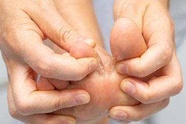 Preventing Diabetic Foot Complications Daily Foot Care and Early Detection