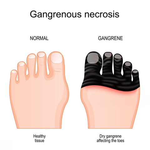 Embracing Care Navigating the Challenges of Diabetes and Dry Feet