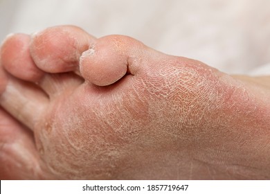 Embracing Care Navigating the Challenges of Diabetes and Dry Feet