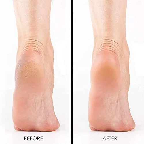 Foot Callus Removal - Unlocking the Secrets to Smooth, Healthy Feet