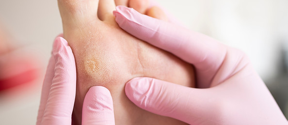 Foot Callus Removal - Unlocking the Secrets to Smooth, Healthy Feet